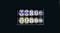 CNNE 1376138 - ¿que es la degeneracion cerebral cte y que la produce?