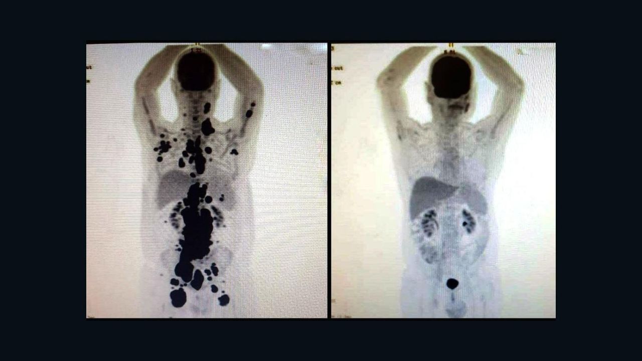 CNNE 1402213 - el impactante antes y despues de un paciente con cancer