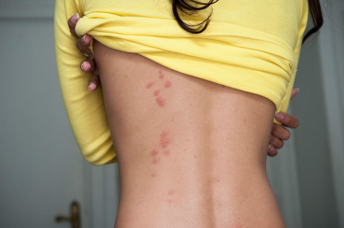 Picaduras de chinches visibles en la espalda de una mujer en una habitación de hotel. Crédito: Joel Carillet/iStockphoto/Getty Images