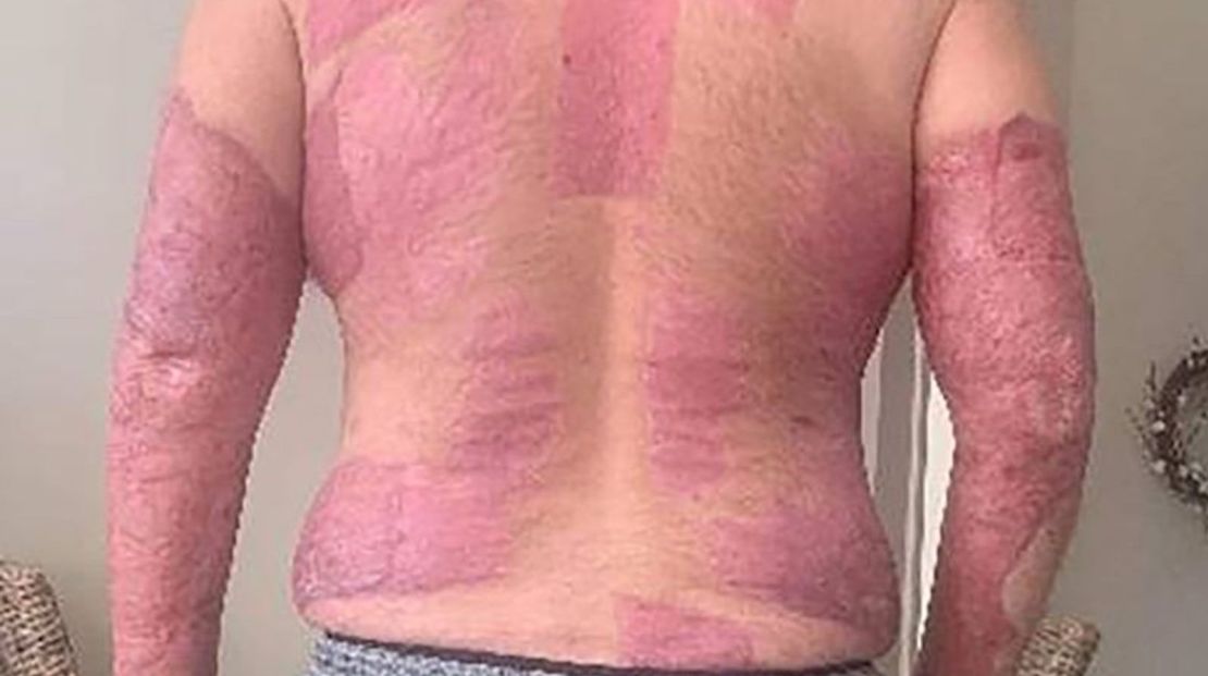 Imágenes de las heridas de Matthew Urey infligidas durante la erupción de Whakaari/White Island.