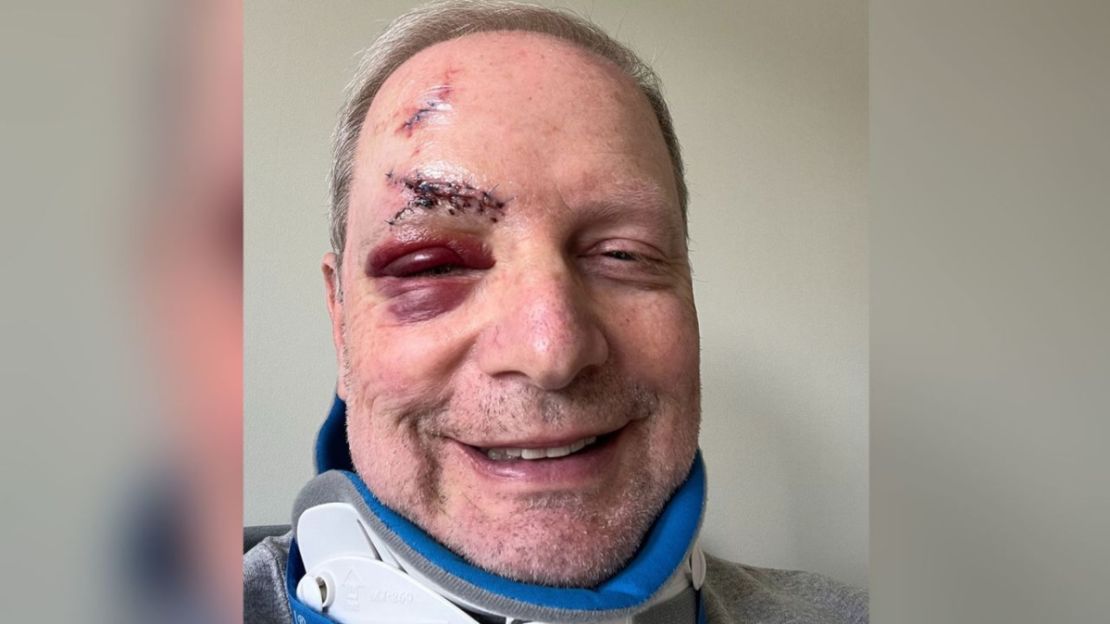 El Dr. Robert Wachter publicó una imagen de sí mismo tras su caída en la que mostró sus heridas y puntos de sutura.