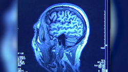 CNNE 1445219 - estudio encuentra signos tempranos de trastorno en cerebros de atletas