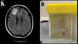 CNNE 1445291 - extraen un gusano parasito de 8 centimetros del cerebro de una mujer