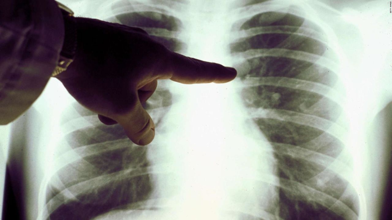 CNNE 1553778 - las claves para prevenir el cancer, segun especialista