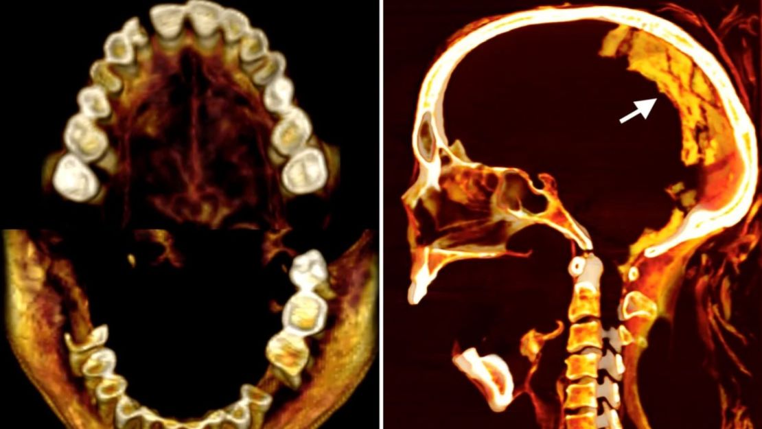 Las tomografías computarizadas, incluidas las de los dientes (izquierda) y el cerebro, han revelado nuevos detalles sobre la morfología, el estado de salud y la conservación de la momia.