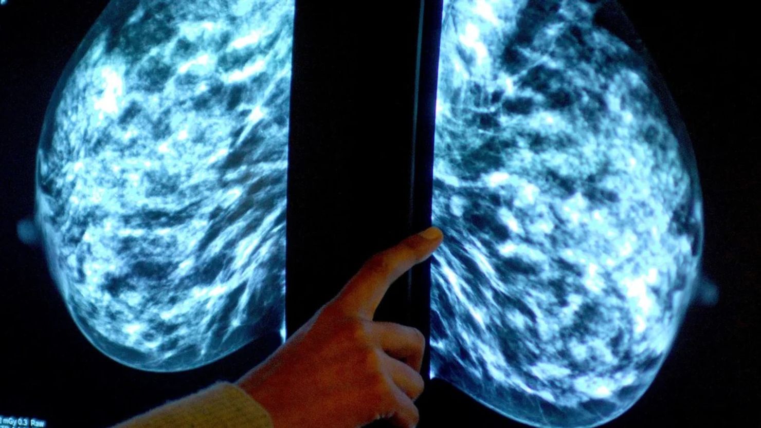 CNNE 1739028 - cancer seno mama mamografia