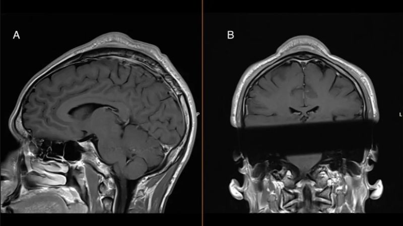 A man develops a 30cm tumor on his scalp after decades of breakdancing