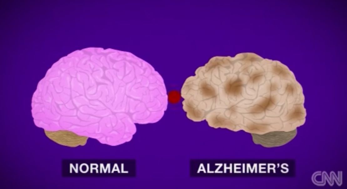 Actualmente son capaces de ver la diferencia entre un cerebro sano y uno afectado.