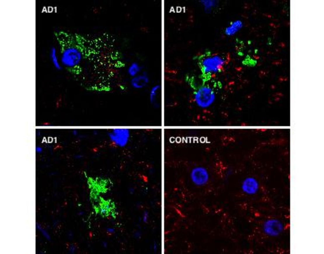 Análisis de estructuras fúngicas en tejido de cerebro mediante inmunohistoquímica.