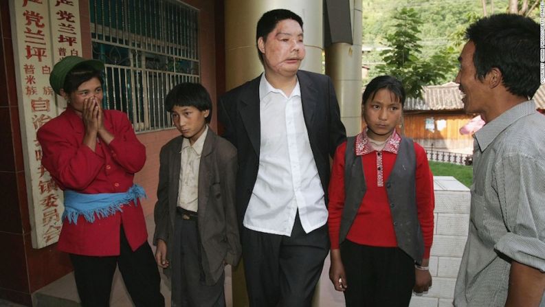 Li Guoxing – Li Guoxing, el primer paciente de un trasplante parcial de cara de China, posa con su familia en el condado de Lanping en la provincia de Yunnan en 2006. Él murió en 2008.