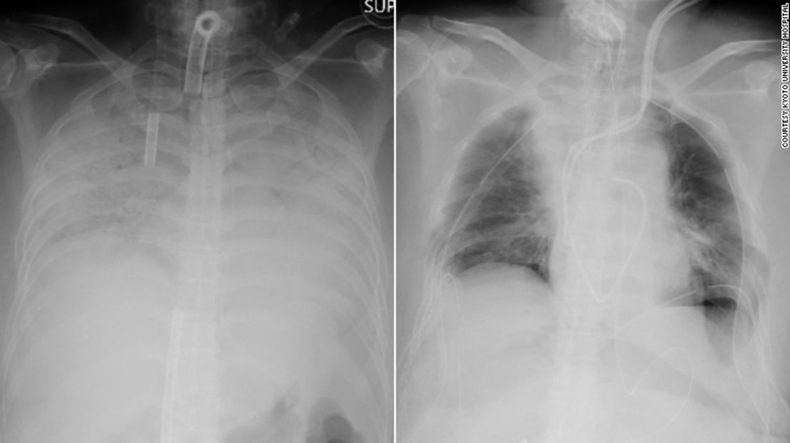 Las imágenes de rayos X muestran a la izquierda el tórax de la paciente antes de la operación de trasplante. A la derecha está la misma radiografía, pero después de la operación. Las áreas oscuras indican dónde se trasplantó el tejido pulmonar.