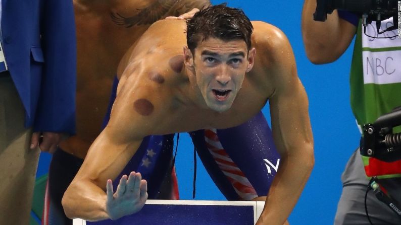 Agosto 7: Phelps es durante la competencia de relevo 4x100m libre. Las marcas rojas en su hombro son el resultado de una terapia antigua usada en Asia y Oriente Medio para la recuperación de músculos.