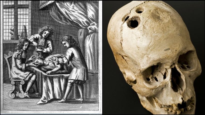 Trepanación — Esta práctica consistía en cavar huecos en el cráneo para curar enfermedades de la cabeza como migraña y exceso de inflamación. Expertos creen que es la forma más antigua de la neurocirugía.