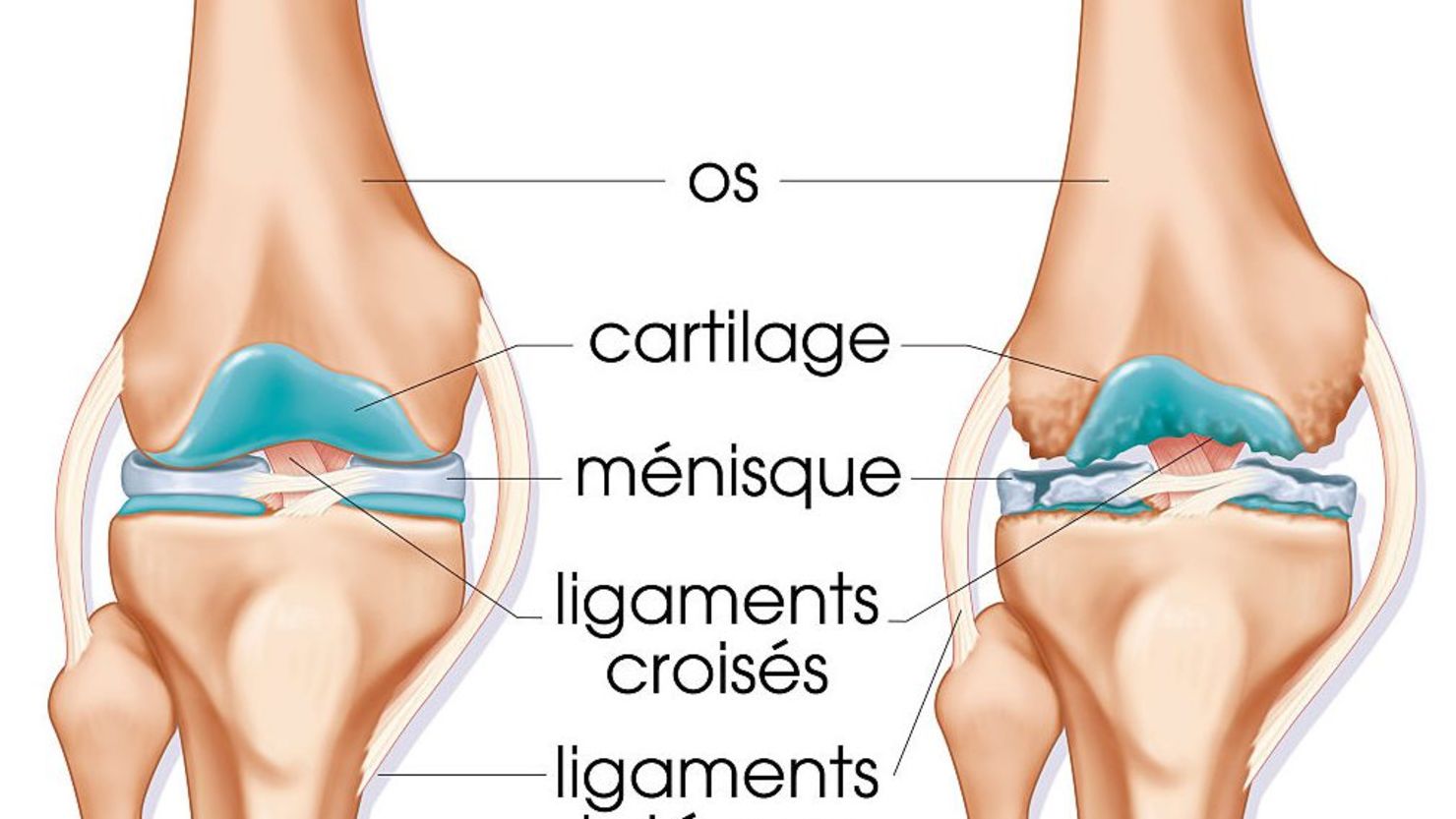 CNNE 324371 - osteoarthritis, illustration
