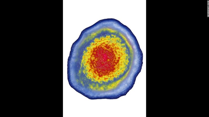 El citomegalovirus es uno de los virus menos conocidos de la familia de los herpes que pueden transmitirse con un simple beso. La mayoría de nosotros tiene anticuerpos que luchan contra el virus y nunca se enteran que lo sufrieron. Eso sucede porque los adultos sanos o los niños no desarrollan síntomas con este virus. Puede transmitirse con la saliva, la sangre, el semen, la orina y la leche materna y crear serios problemas en personas con enfermedades inmunológicas.