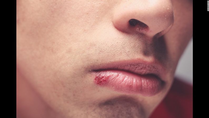 Los molestos fuegos en la boca son el resultado del virus del herpes simple. Un beso rápido puede pasárselo a tu pareja e incluso a tus hijos. El contagio puede suceder incluso cuando el fuego no se ha formado en la boca pero ya se ha contraído el virus.