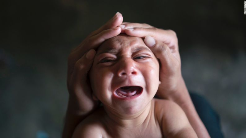 Enero 30: Jose Wesly, un bebé nacido con microcefalia, llora en Bonito, Brasil. La microcefalia es un desorden neurológico que resulta en el nacimiento de bebés con cabezas anormalmente pequeñas y con desarrollo cerebral anormal. Un brote de zika fue vinculado a estos nacimientos.