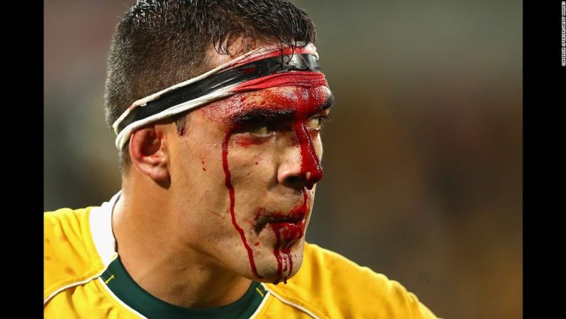 Junio 18: El jugador australiano de rugby Rory Arnold resultó herido en la cabeza durante un partido contra Inglaterra, en Melbourne.