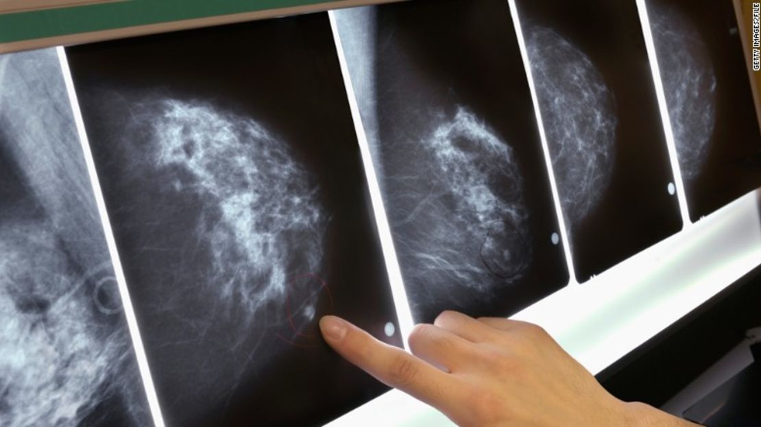 CNNE 380946 - 111018092923-mammogram-breast-cancer-x-ray-exlarge-169