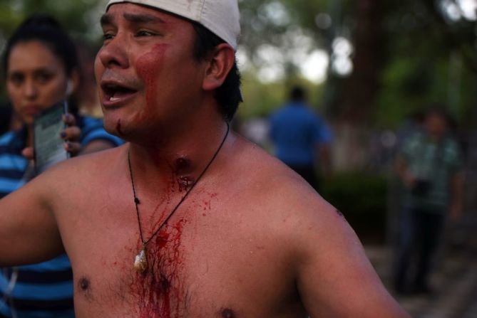 Un manifestante herido durante enfrentamientos con la policía durante las protestas por la enmienda constitucional que fue aprobada este viernes en el Congreso de Paraguay.