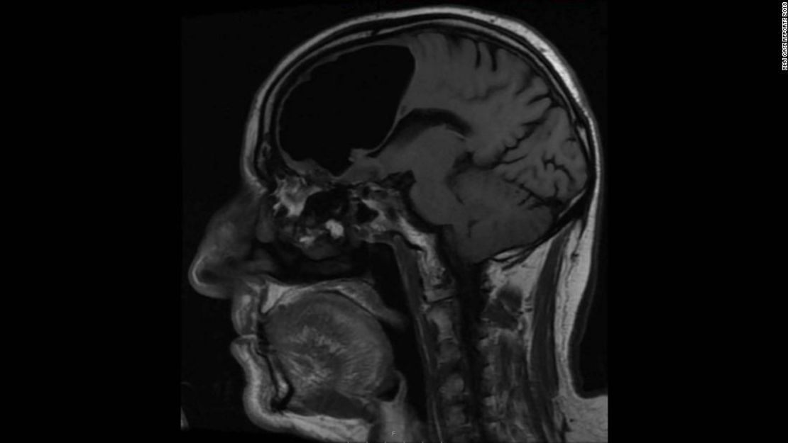 Esta resonancia muestra la cavidad con aire en el cerebro del paciente.