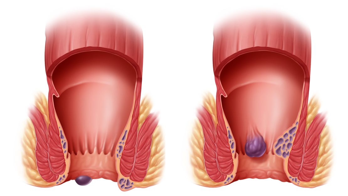 CNNE 427988 - hemorrhoids-internas-externas