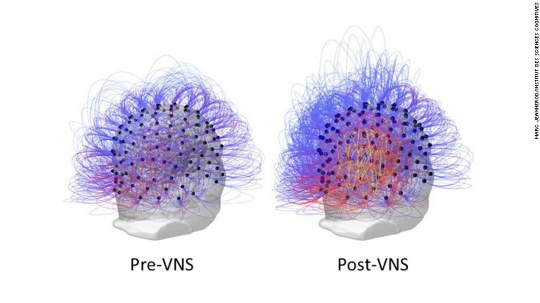 Imágenes de electroencefalograma muestran un aumento en la información compartida a través del cerebro, simbolizada en los colores amarillo y naranja. Este resultado se produjo después de estimular el nervio vago.