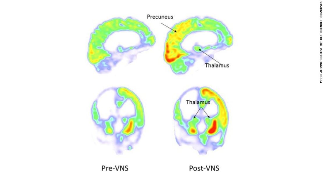 Imágenes de una tomografía por emisión de positrones muestran áreas del cerebro donde el metabolismo de la glucosa, necesario para la función mental, aumentó después de la estimulación del nervio vago.