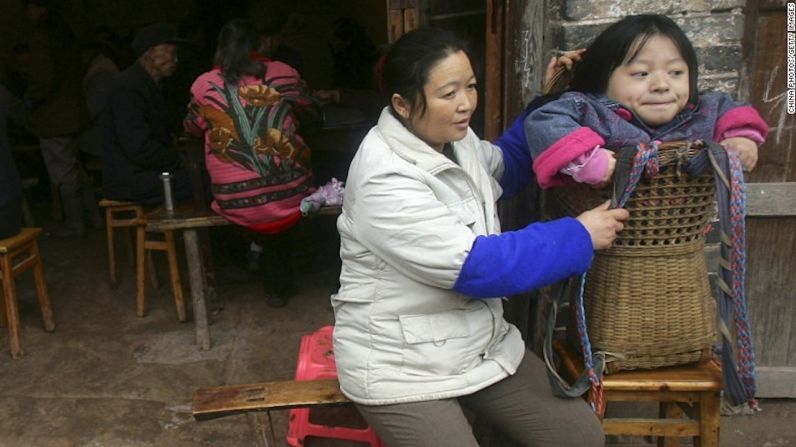 Esta mujer de 19 años en Neijiang, China, está siendo transportada en una canasta porque tiene raquitismo. El raquitismo, una enfermedad causada por la falta de vitamina D —que se obtiene de la luz del sol—, ablanda y debilita los huesos de los niños. Expertos creen que el raquitismo está de regreso en países desarrollados por el uso de bloqueadores solares y porque las personas pasan menos tiempo al aire libre.