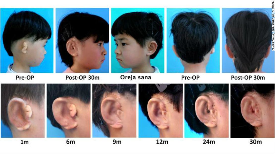 CNNE 488740 - oidos nuevos 3d ninos enfermos