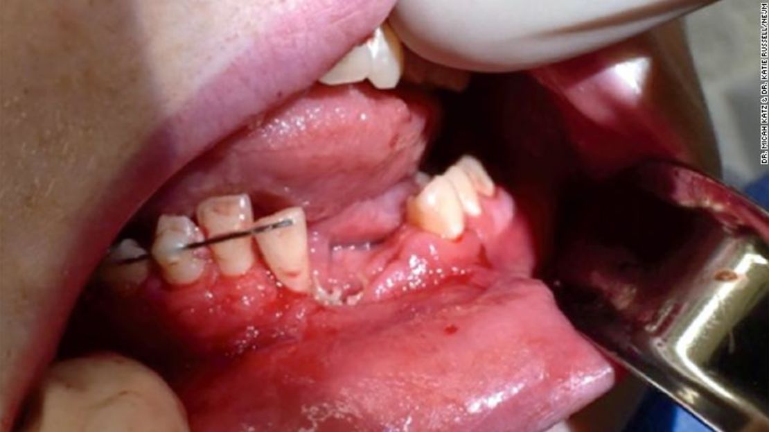 El joven se curó después de seis semanas y dos cirugías, a pesar de que aún no ha recibido implantes de los dientes que perdió.