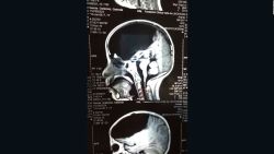 CNNE 527412 - gabriela nacio sin la tercera parte de su cerebro