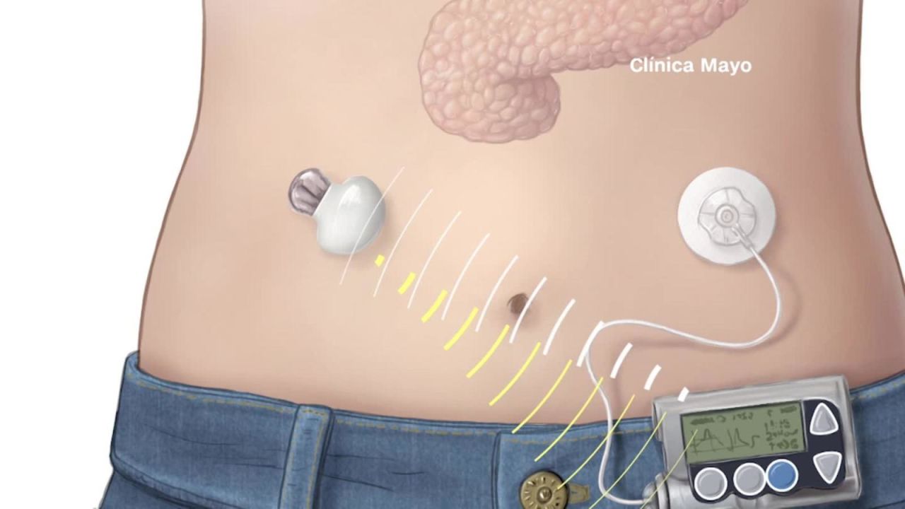 CNNE 528658 - tecnologia para controlar la diabetes