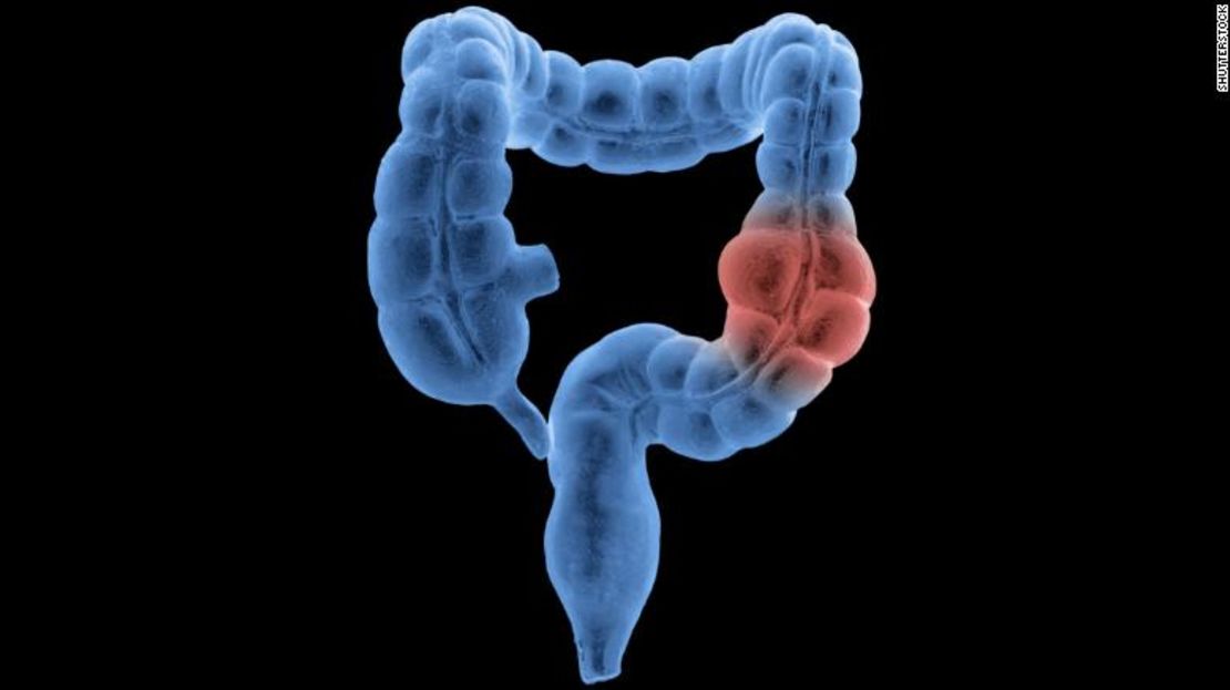 El cáncer colorrectal, que incluye el cáncer de colon y el de recto, es la tercera causa de muerte por cáncer en el mundo, según la Organización Mundial de la Salud.