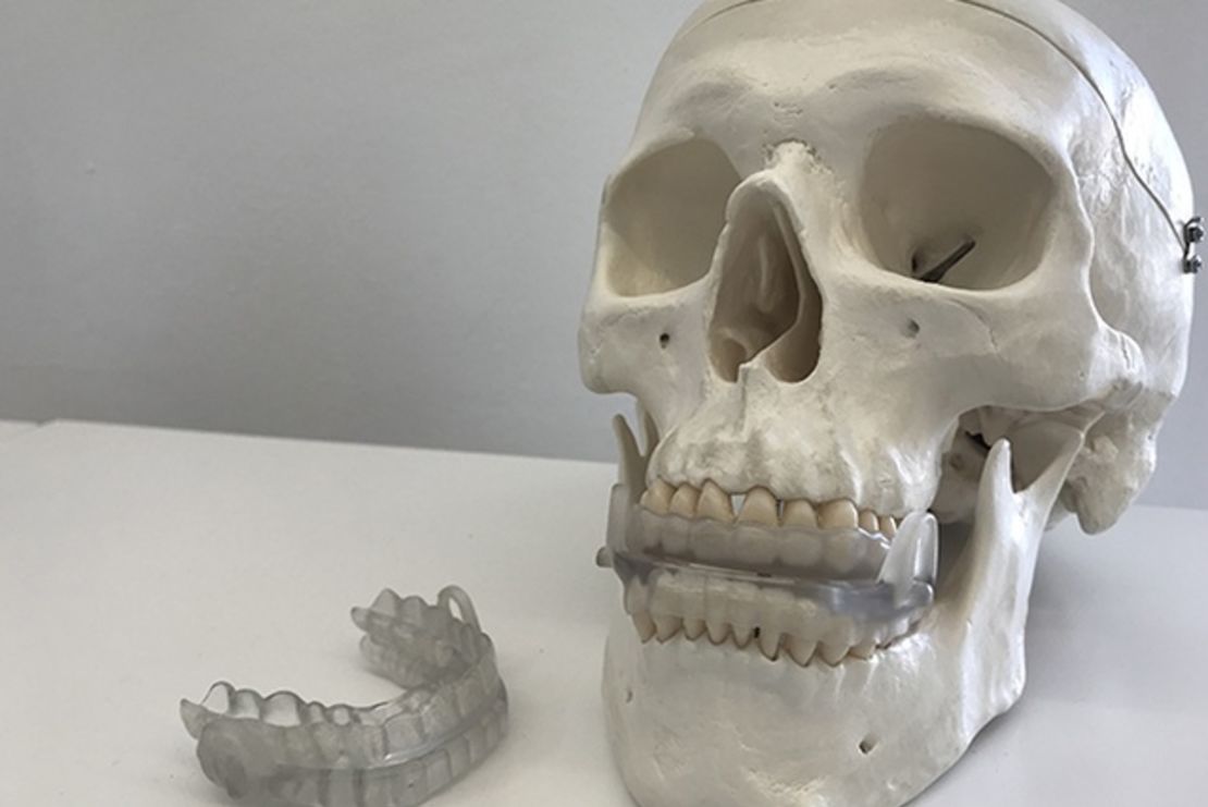 El dispositivo bucal creado para prevenir la apnea del sueño se produce en impresora 3D.