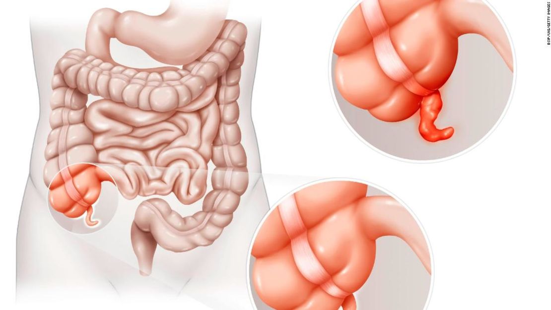 El apéndice guardaría una relación con la enfermedad de PArkinson.