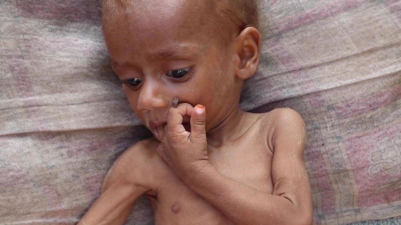 CNNE 590107 - 85-000 ninos han muerto en yemen por hambruna