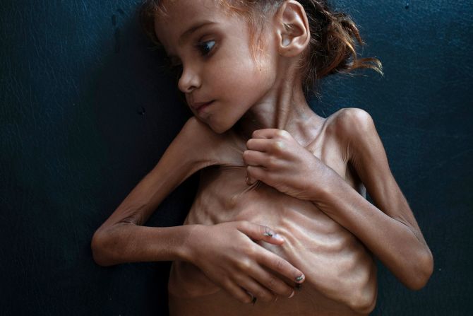 18 de octubre - Amal Hussain, una niña de 7 años que sufre de desnutrición, se yace en una cama en una clínica móvil de UNICEF en Aslam, Yemen. Murió días después de que The New York Times publicara una historia sobre ella y la crisis del hambre en Yemen. Tyler Hicks / The New York Times / Redux