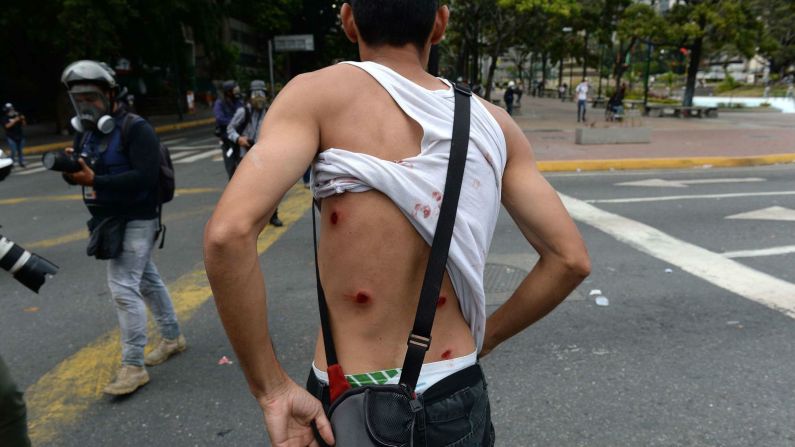 Un manifestante herido muestra su espalda mientras la policía antidisturbios se enfrentaba con manifestantes opositores en Caracas el 23 de enero. (Féderico Parra / AFP / Getty Images).