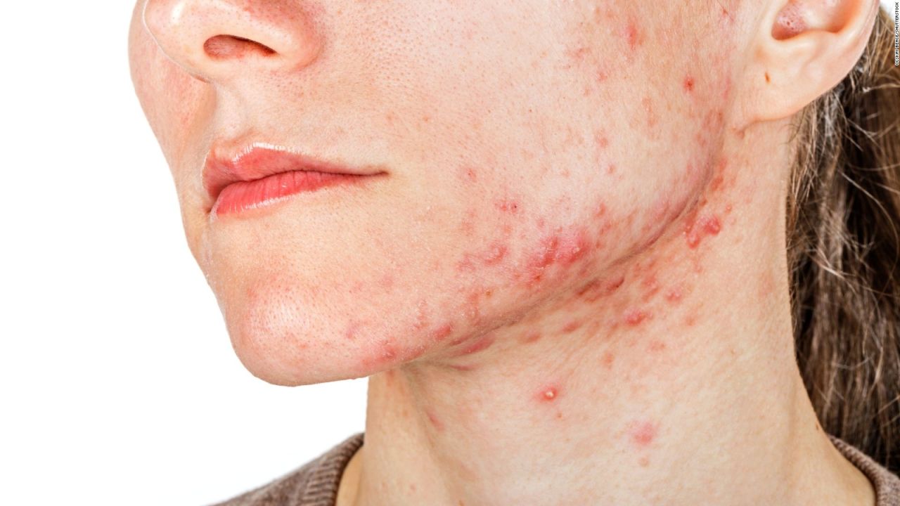 CNNE 626470 - los mitos y verdades del acne