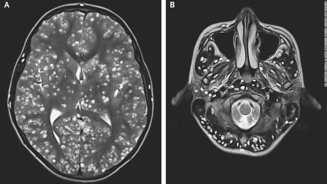 En las imágenes de resonancia magnética de la corteza cerebral y el tronco cerebral del paciente se pudieron apreciar quistes que causan daños.