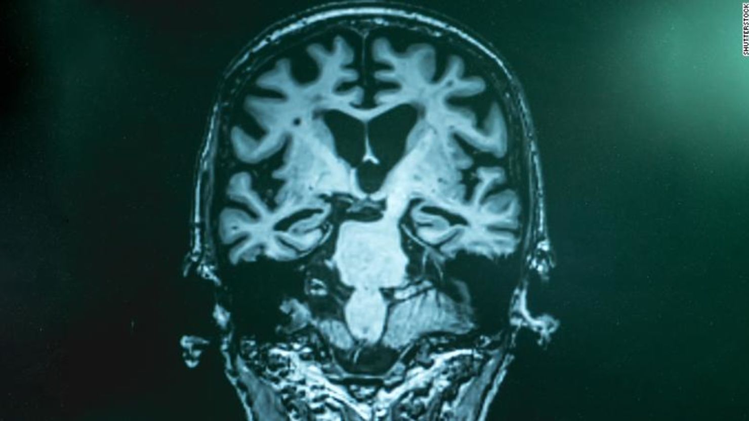 CNNE 643263 - 190426120023-01-alzheimer-video-game-exlarge-169
