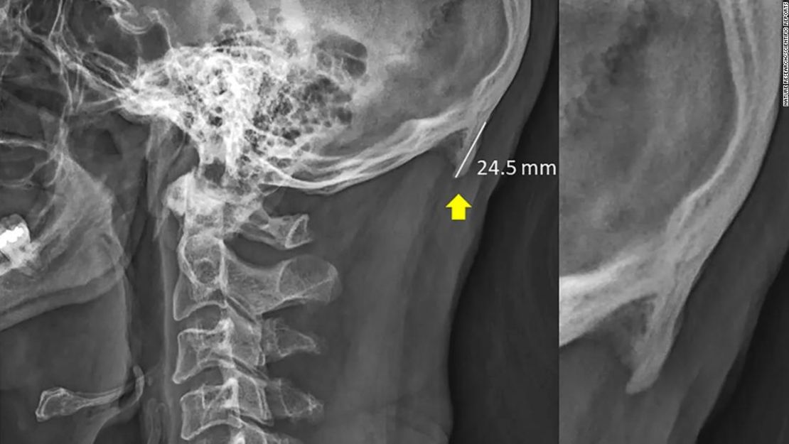 Radiografía de un hombre de 28 años que participó en el estudio.