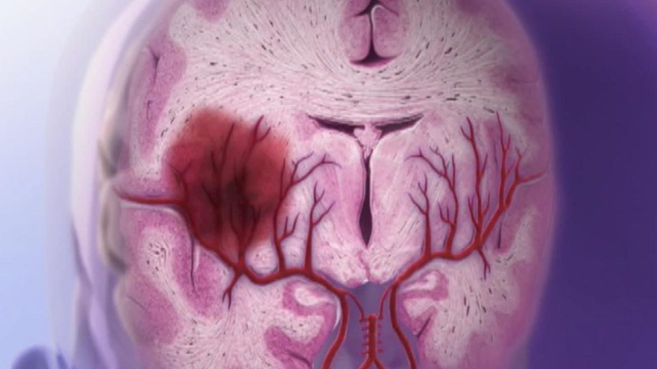 CNNE 667065 - aprende a identificar las senales de un derrame cerebral