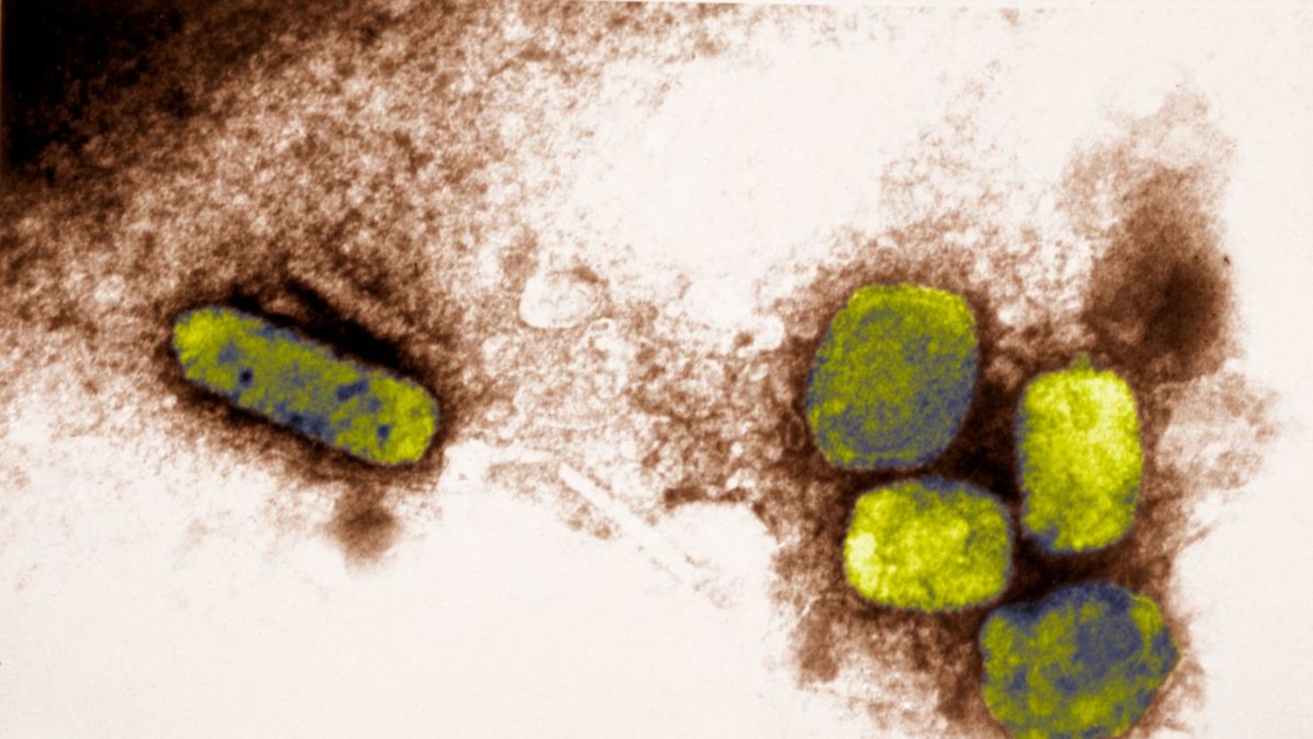 CNNE 704984 - 180713161228-smallpox-treatment-restricted