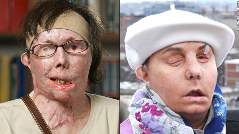 Carmen Tarleton, antes y después del trasplante. En 2007, su esposo del que estaba separada la atacó con una botella de lejía, desfigurando su rostro más allá del reconocimiento y quemando el 85% de su cuerpo. Pasó años con dolor, especialmente en la cara y el cuello mientras los injertos de piel se estiraban más y más.