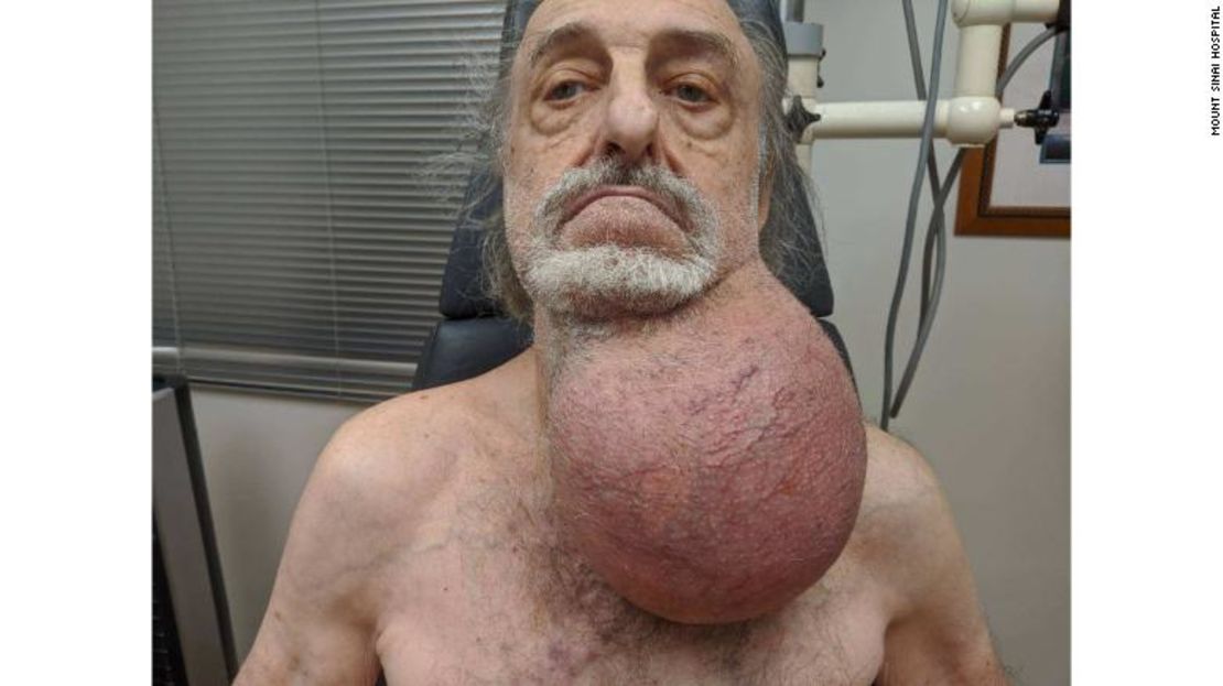 El tumor de Milton Wingert antes de la cirugía.