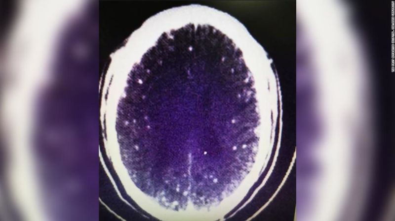 Neurocisticercosis: un hombre tuvo convulsiones después de comer un caldo. Resulta que tenía tenias en el cerebro | cnn