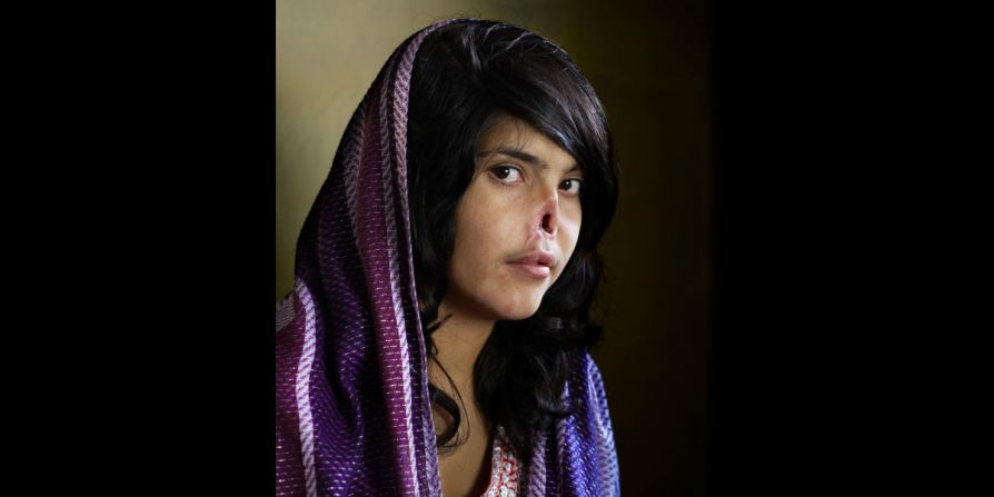 Esta foto de la mujer afgana Aesha Mohammadzai apareció en la portada de la revista Time en agosto de 2010. Su esposo y suegros talibanes la castigaron por huir cortándole la nariz y las orejas y dejándola creyendo que estaba muerta. Se convirtió en un símbolo de la opresión de las mujeres en su país devastado por la guerra. Fue trasladada a Estados Unidos, donde se sometió a múltiples cirugías para reconstruir su nariz.