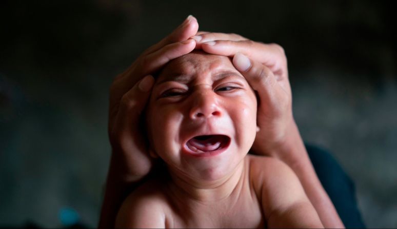 Jose Wesley, un bebé nacido con microcefalia, llora en Bonito, Brasil, en enero de 2016. La microcefalia es un trastorno neurológico que provoca que los niños nazcan con cabezas pequeñas y un desarrollo cerebral anormal. Un brote del virus Zika fue vinculado a una oleada de bebés con este defecto congénito.